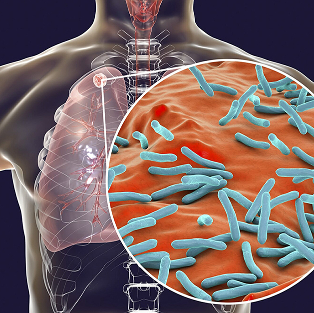 Tuberculosis (TB)